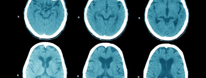 Meditatietype en hersenverandering gelinkt - Re-Minding Mindfulness